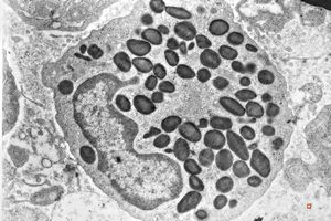M,66y. | bone marrow - eosinophilic granulocyte